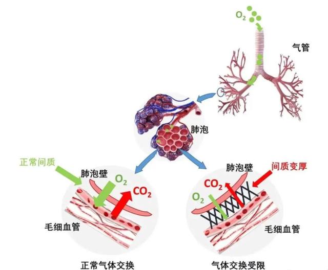 肺间质示意图图片