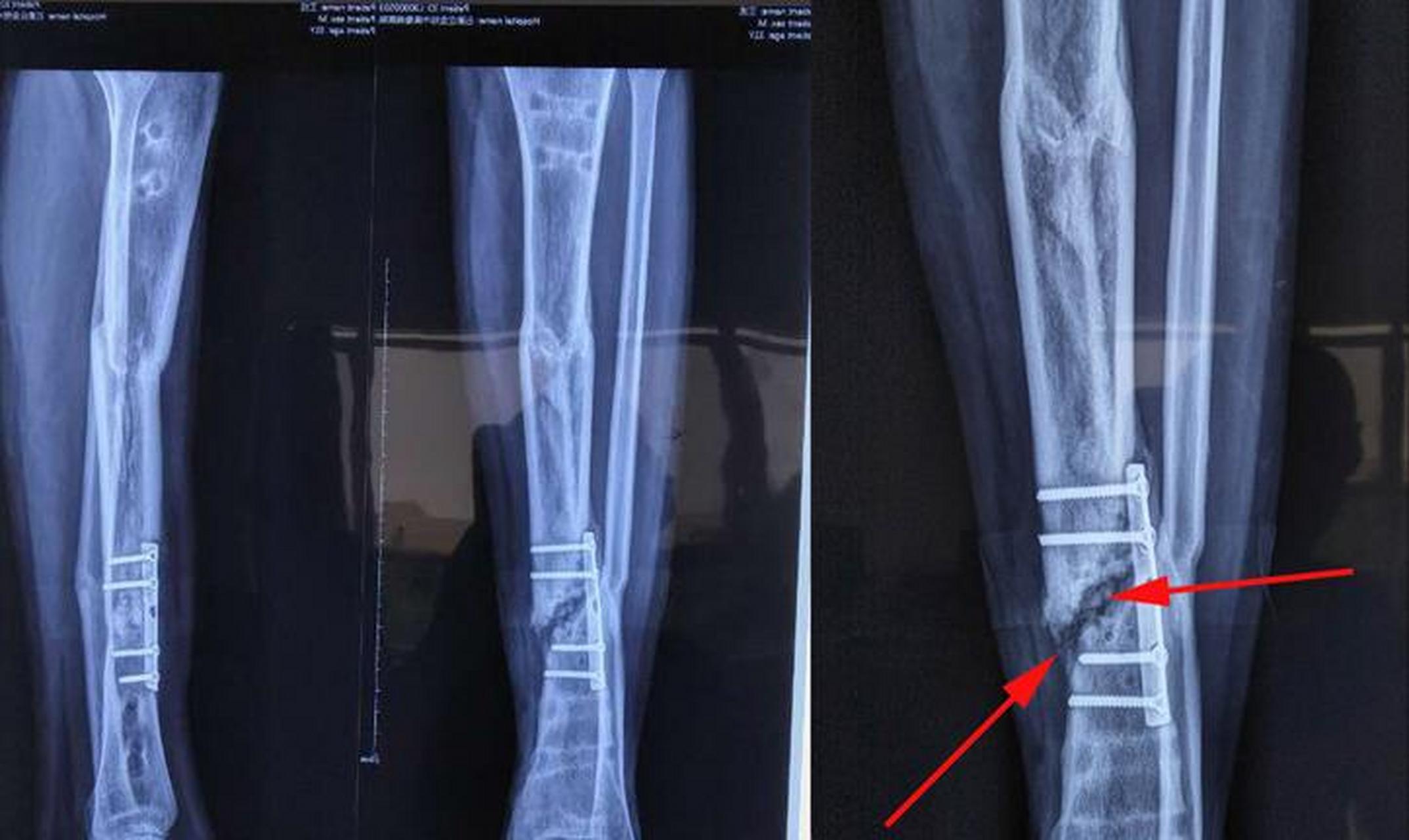 【骨折延迟愈合的治疗方法】 骨折不愈合或骨折延迟愈合的方法主要有