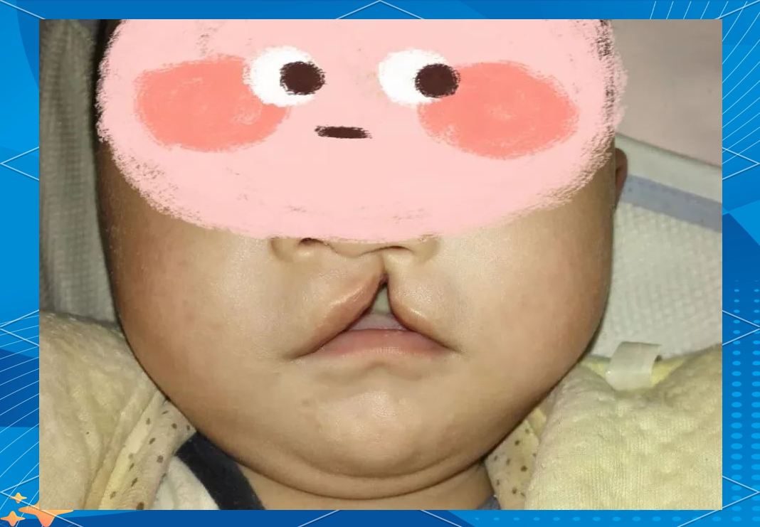 唇腭裂知识全解析:发生,预防与手术时机