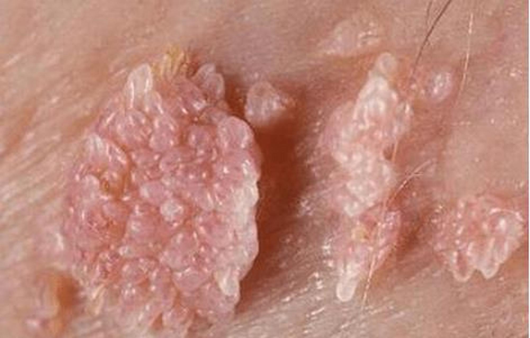 宫颈癌身上疙瘩的图片图片