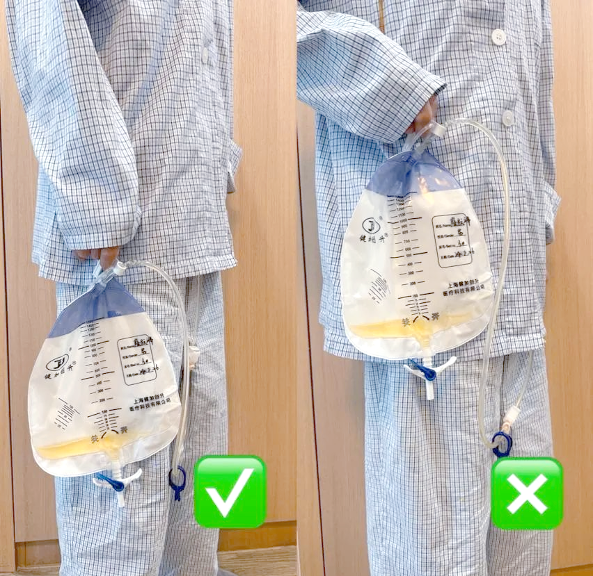 妥善固定,严防滑脱导尿管的前端通过注入适量生理盐水或空气的气囊,在