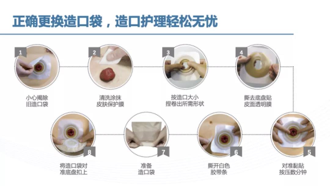 纯干货丨肠造口患者的居家护理宝典