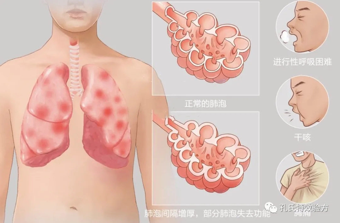 你了解肺心病的症状吗