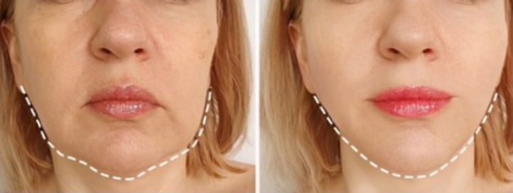 v脸变方脸?嘴角"嘟嘟肉"?可能是整形美容界难点——口角囊袋