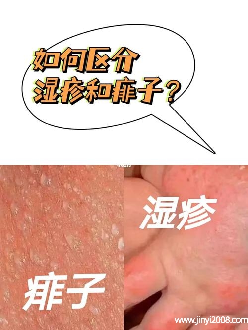 痱子和湿疹怎么区分(婴儿湿疹用金银花洗有效吗)