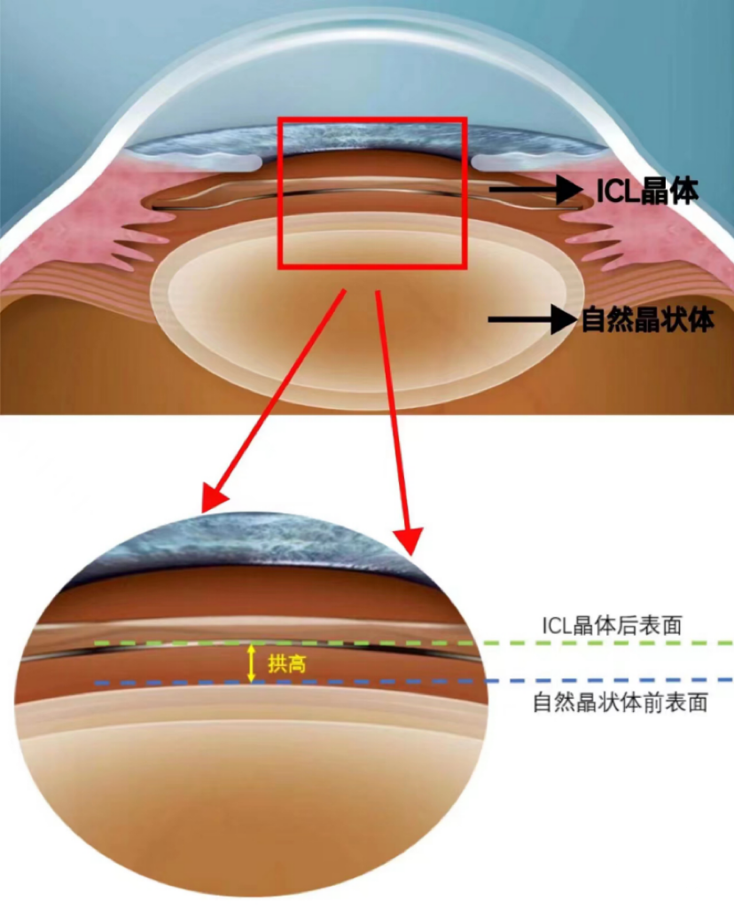 icl手术与拱高的关系!