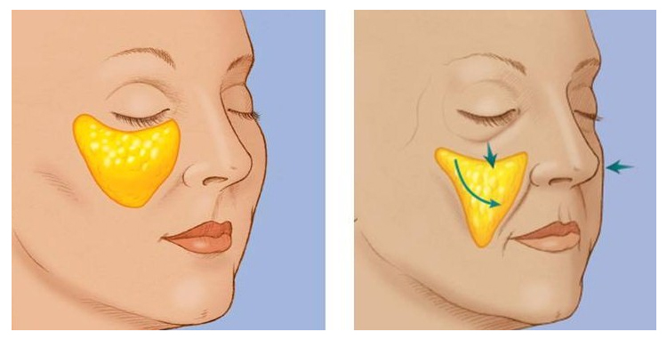 「杭州艺星」玻尿酸填充苹果肌后会出现移位,是真的吗?