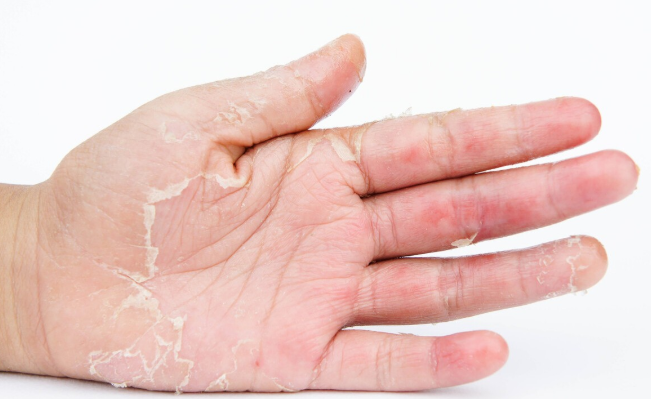 维生素b3是治疗皮肤病的常用药,缺乏b3的临床表现,这5类人易得