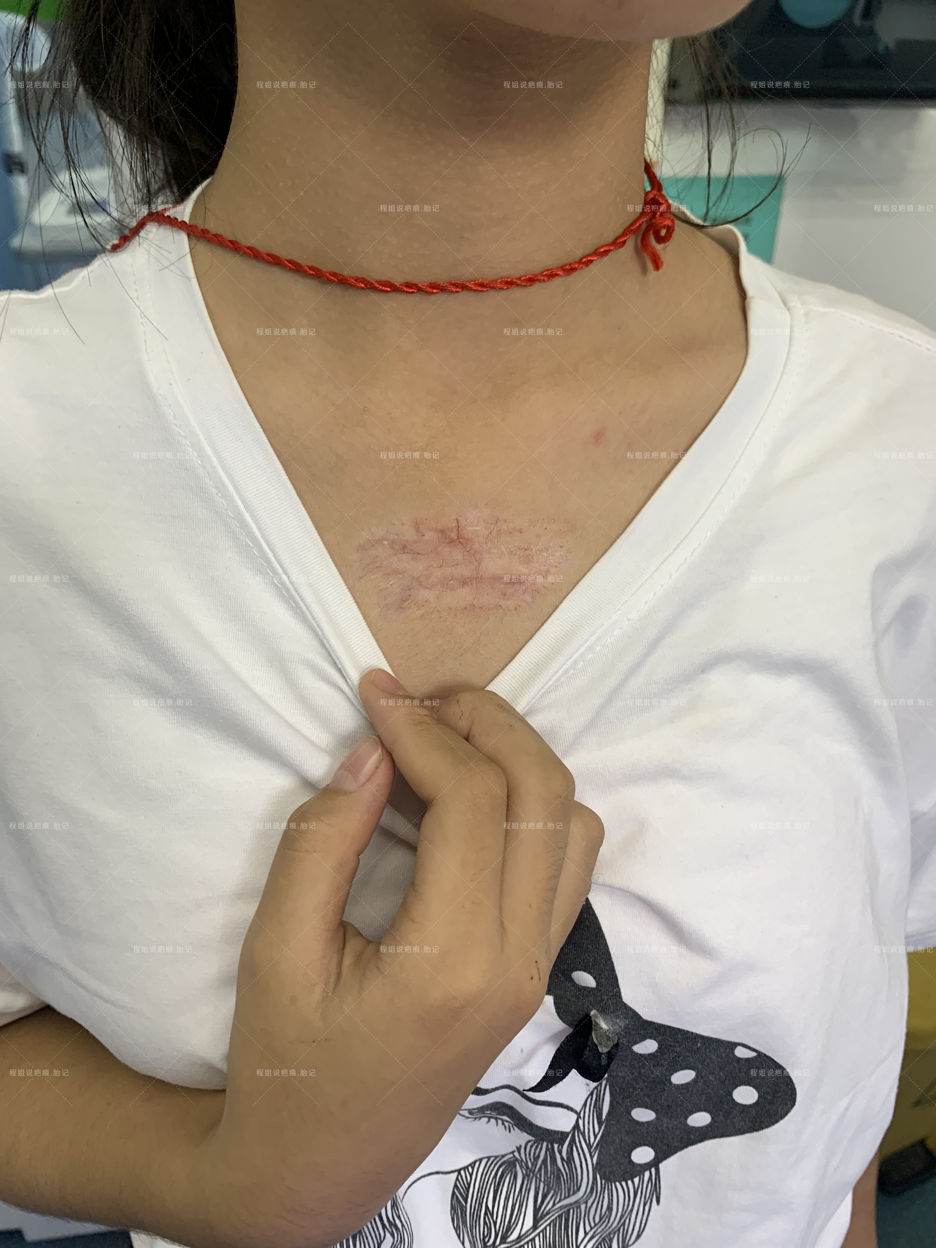 胸口的痘痘增生了一个大疙瘩出来,我是如何把它去掉的?