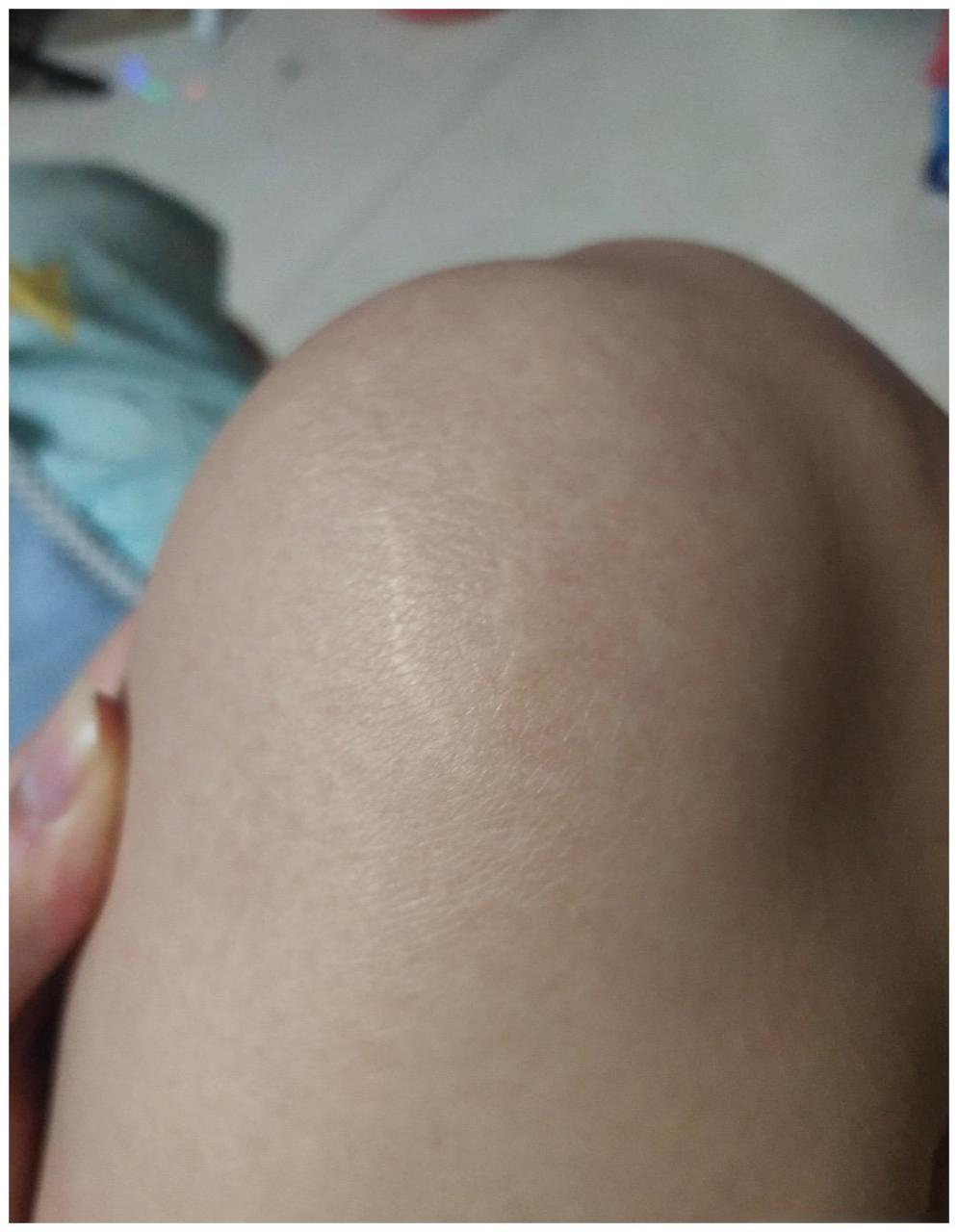 今天和女朋友分手了,无看到她腿上有这个妊娠纹,她还不承认,说是什么