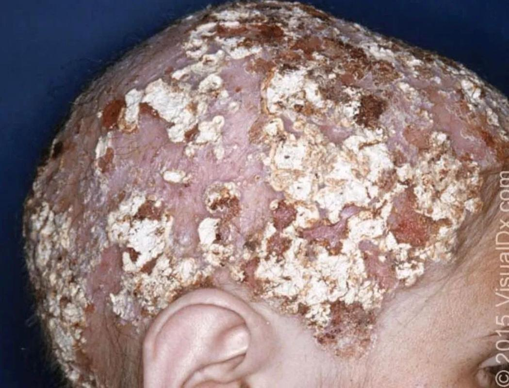 青少年掉发成因全方位探讨:习惯,健康与压力的多重影响