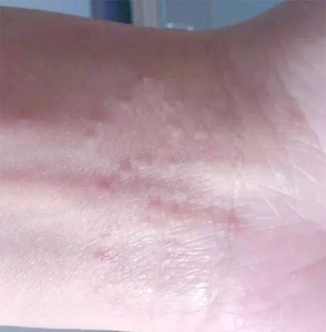 手腕突发小疙瘩伴瘙痒,警惕皮肤过敏风险