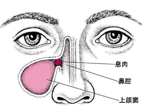 上颌窦炎怎么治疗最好图片