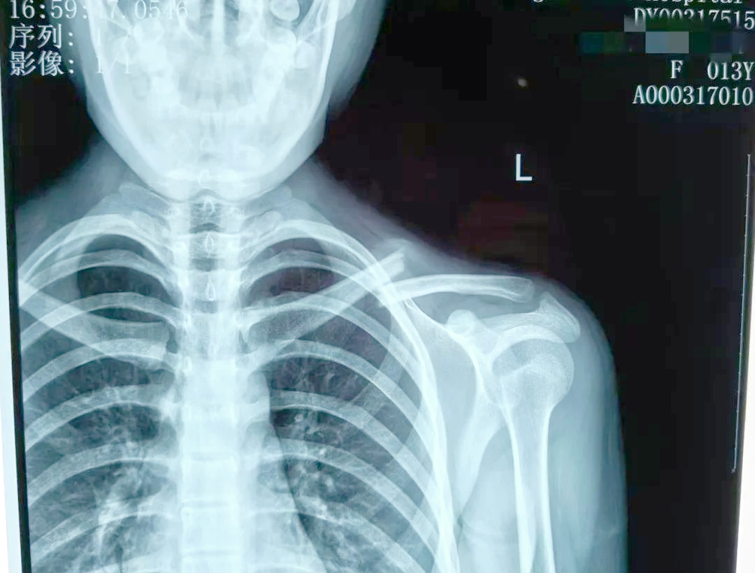 中医正骨助力锁骨骨折治疗,避免手术痛苦