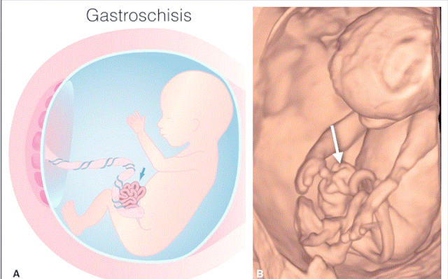 腹裂是一种散发畸形,其出生时发病率为1 : 4000,且通常不伴随染色体