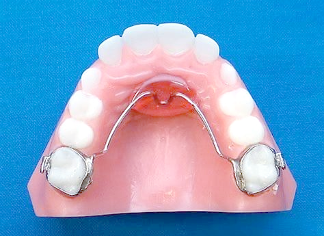 远中导板式间隙保持器,专为孩子设计,当其六龄齿尚未萌出而前面的乳牙