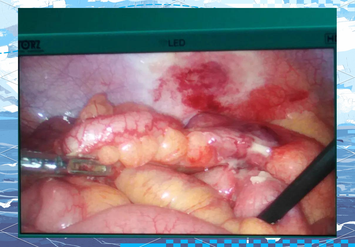 2022年多例手术之一:治疗反复发作的阑尾炎