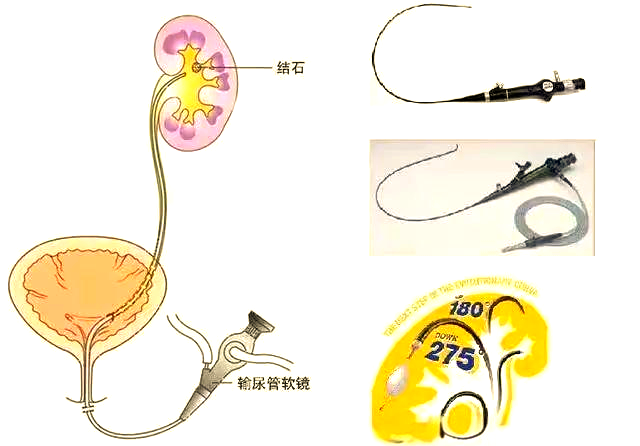 输尿管软镜手术的创新与应用:微创技术的飞跃