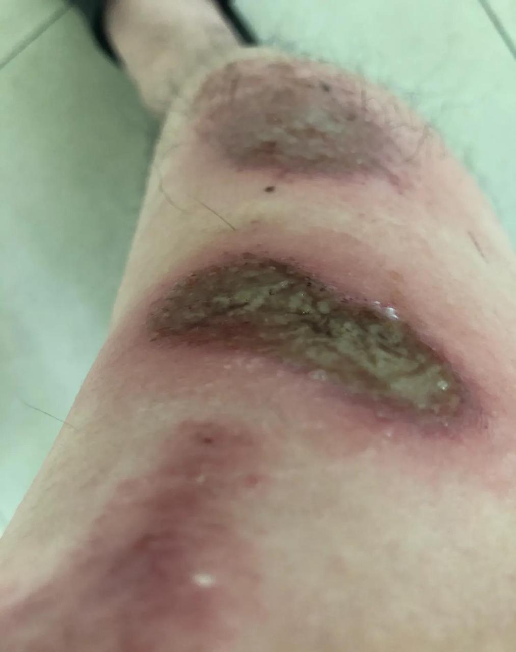 打球摔伤的伤口四天了,突然剧痛一夜,早起无法站立,明显腿肿.