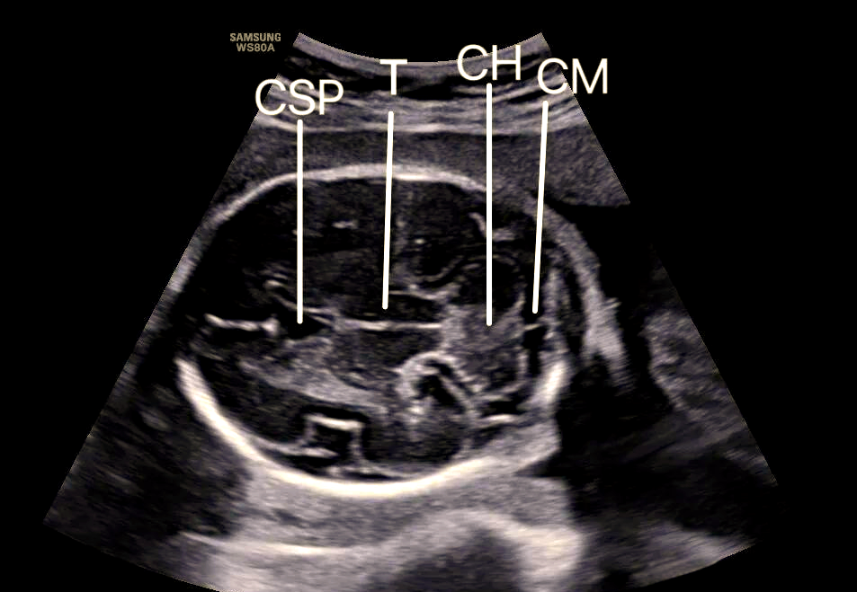 胎儿透明隔腔的超声学习与了解