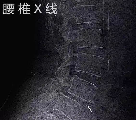 腰椎滑脱程度的分级图解