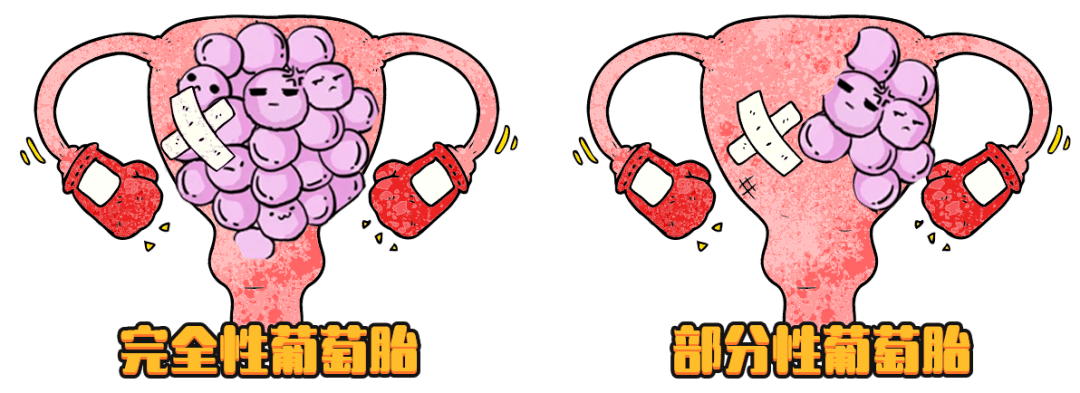 "葡萄胎"是什么?