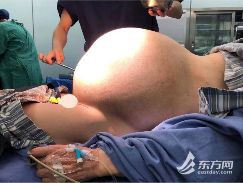 上海一女子腹內藏直徑40釐米腫瘤,竟以為是