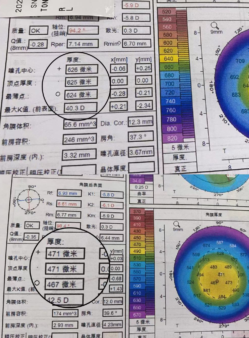 角膜厚度很关键,偏薄偏厚都需要注意!