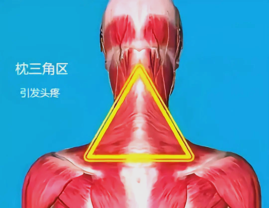 颈部金三角区,即颈后枕骨以下,涵盖第一颈椎和第二颈椎的区域,被誉为"