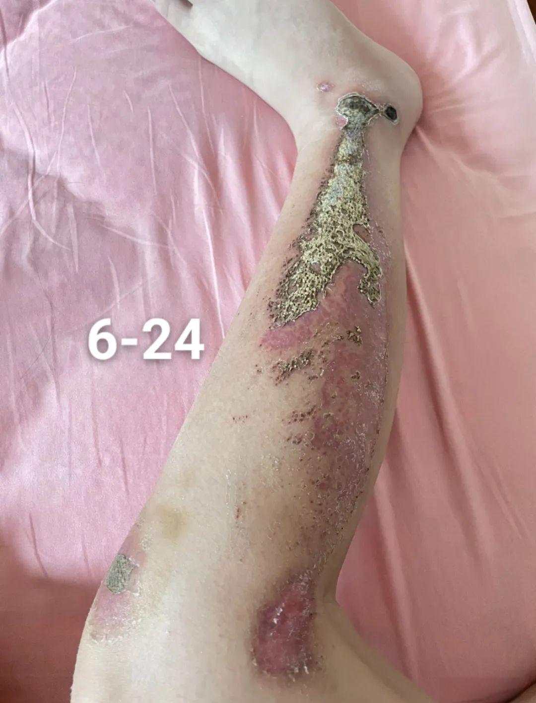 图解伤口愈合:擦伤愈合的自然过程