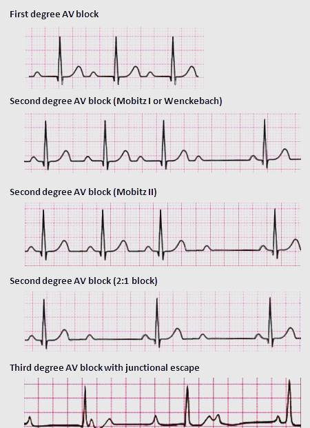 pr间期异常及房室传导阻滞的详细解析