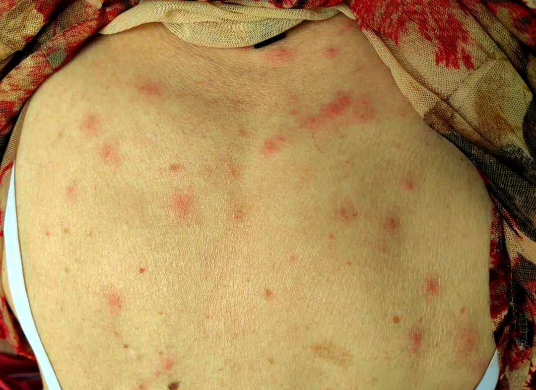 女子睡凉席螨虫过敏?不必谈"螨"色变