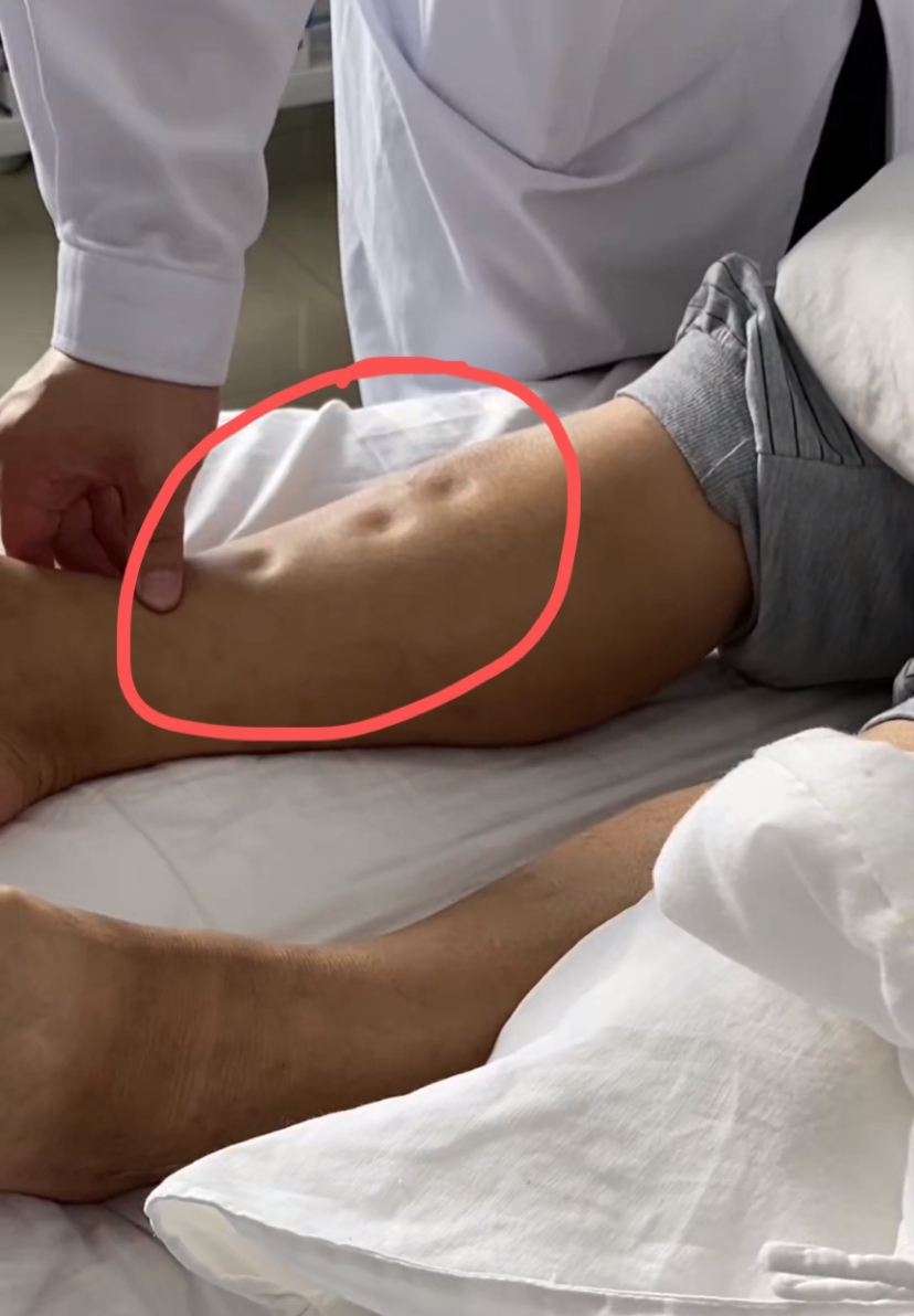 肝硬化患者突然出现腿肿要当心病情在加重!