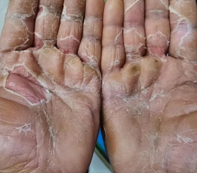 一到冬天,手掌就干燥起皮?医生:多留心这3件事,尤其是老年人