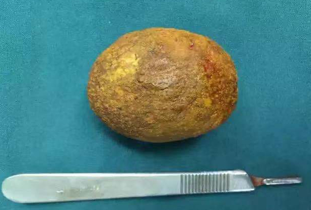 无症状胆囊结石患者复查时发现胆囊壁局部增厚需警惕胆囊癌