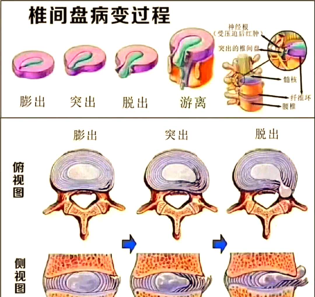 腰痛原因难寻?可能是腰椎间盘纤维环裂缝!
