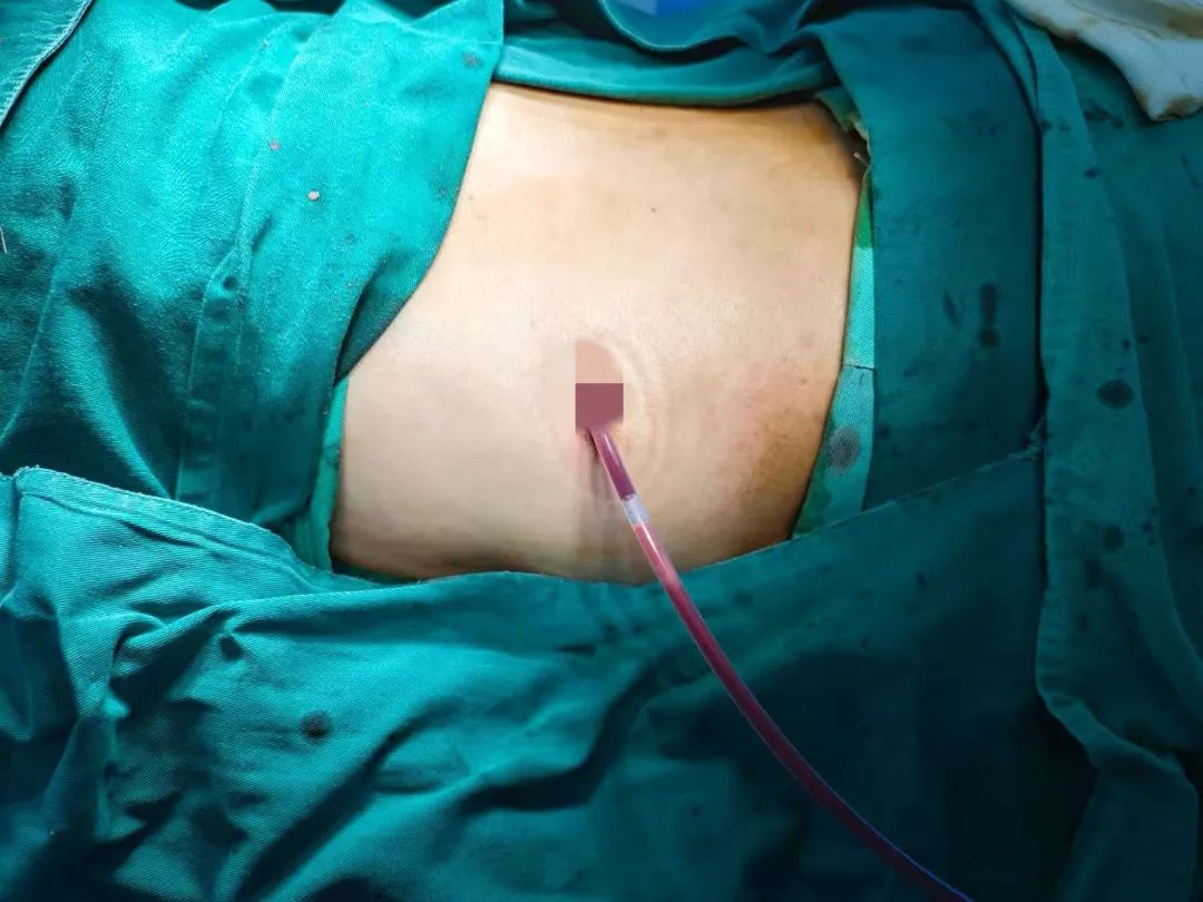 公卫中心泌尿外科成功实施俯卧位单孔腹腔镜肾上腺肿瘤切除术