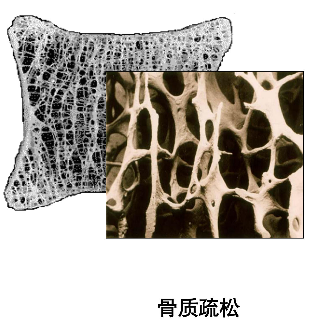 以骨量减少,骨小梁变细,断裂,数量减少,皮质骨多孔,变薄为特征,以致骨