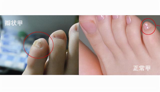 小脚趾头上有2片指甲?会不会预示着什么疾病?