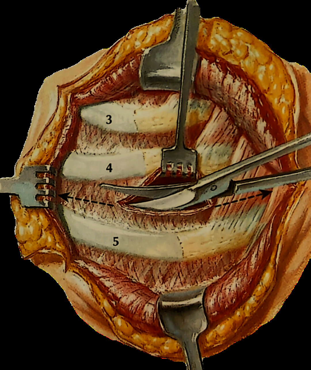 胸部创伤紧急手术的关键技术:胸腔导管置入与开胸操作要点