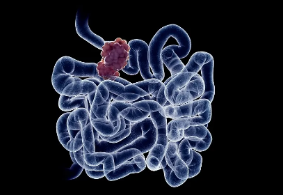 中山大学中山医学院林园团队研发新型溶瘤病毒在治疗结肠癌方面取得