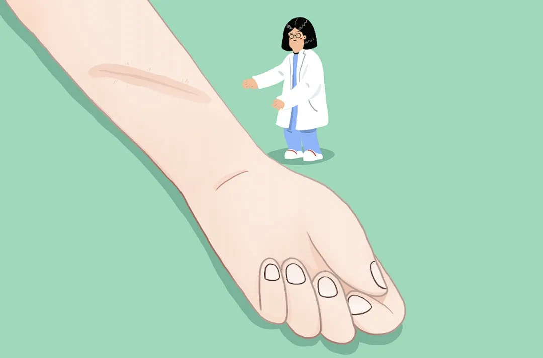 常见的四种凹陷性疤痕,看看你属于哪一种?