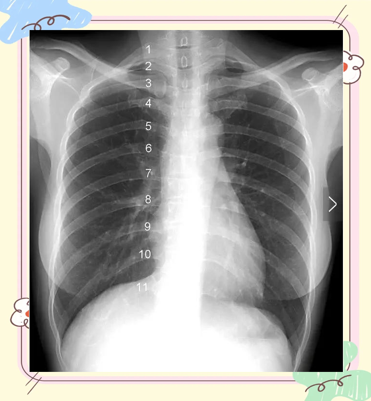 x线入门|正常胸片的分析与解读方法