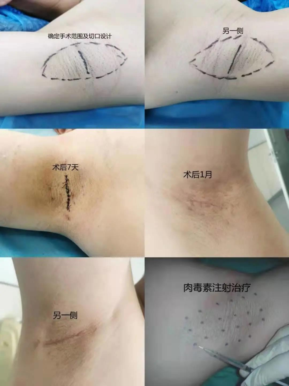 夏季到了深受腋臭困扰?微创手术跟腋臭说"再见"!