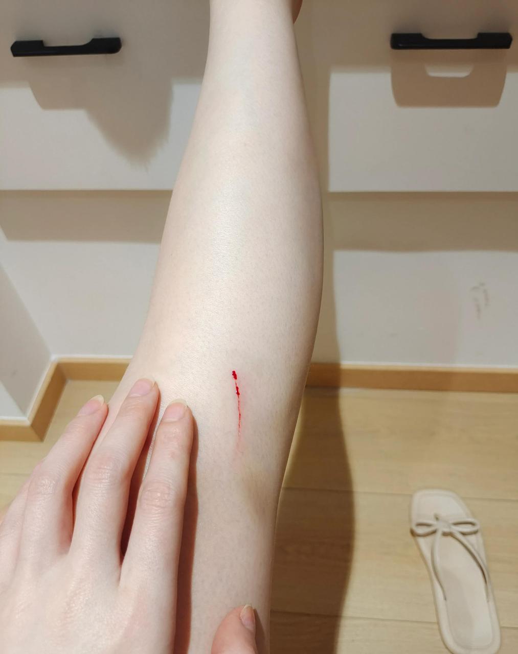 我这伤痕累累的腿呀,这夏天是不让过了嘛?