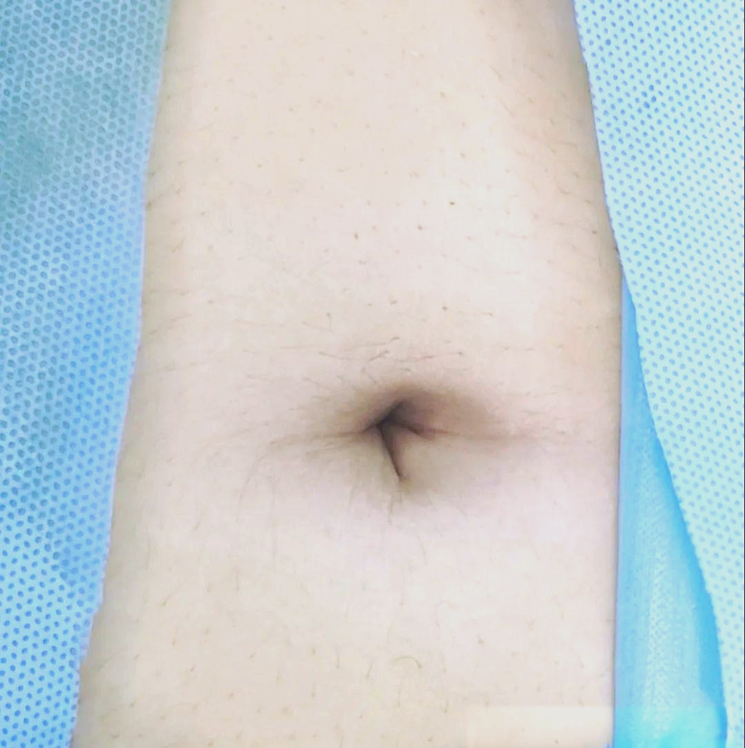 完美无"痕"的阑尾切除新选择