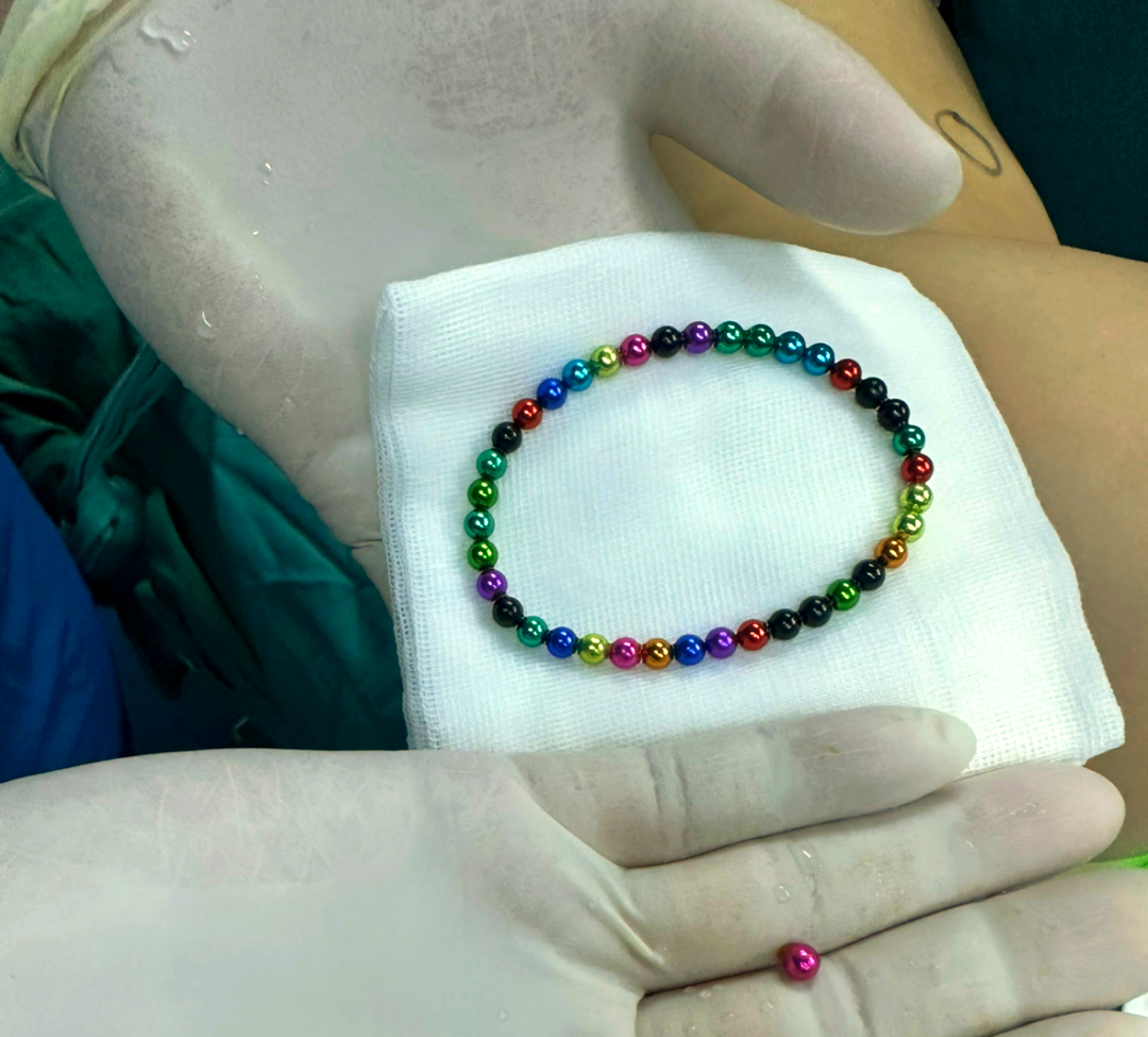 磁力珠吃到肚子里多久有反应啊=磁力珠误食3颗有排出来的案例吗?