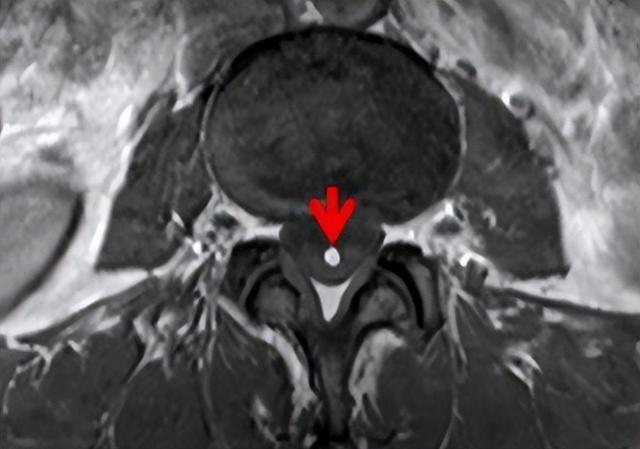 终丝脂肪沉积(fatty filum terminale)