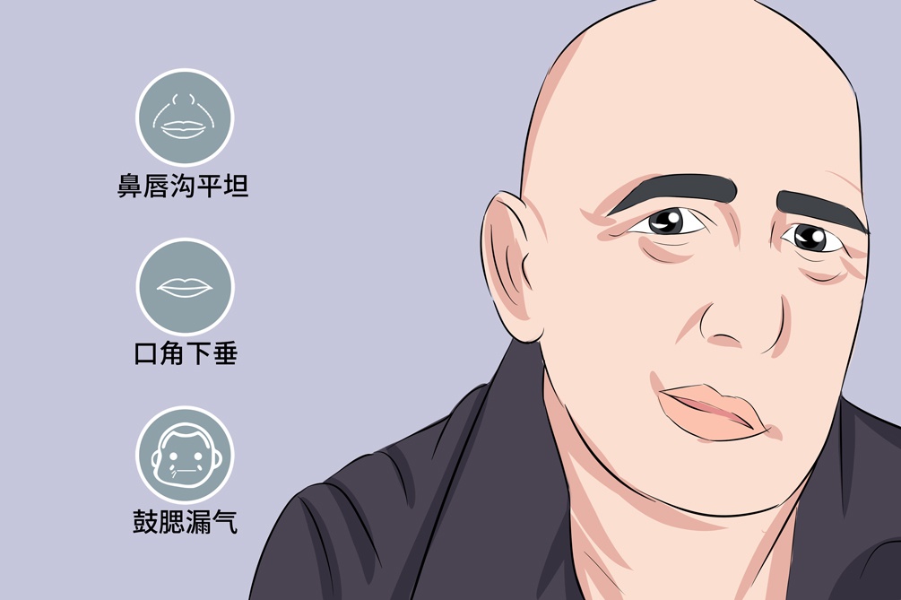 孕期得了面瘫,该如何应对?