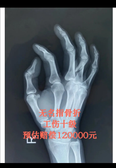 深圳工地小哥无名指骨折,工伤赔偿12万!
